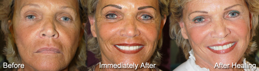 Permanent Makeup